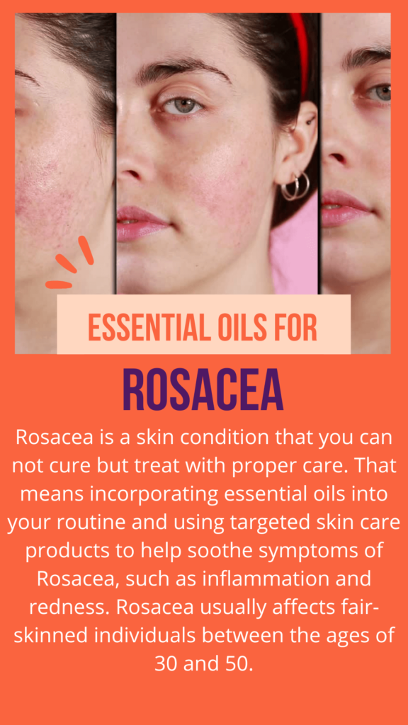 Best Essential Oils for Rosacea