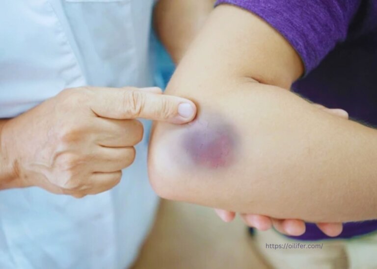 Essential Oils for Bruising| Natural Remedies to Quickly Reduce the Discoloration